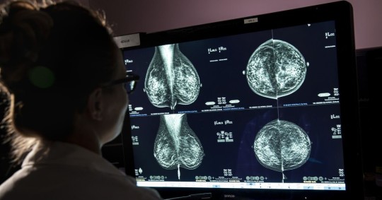 Se pueden identificar hasta un 20 % más de tumores en comparación con los métodos convencionales/ Foto: cortesía 