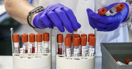 Según la OMS, cada año más de un millón de personas mueren de hepatitis, siendo las más letales las de tipo B y C / Foto: EFE