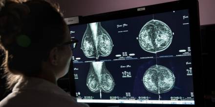 La Inteligencia Artificial, una herramienta contra el cáncer de seno